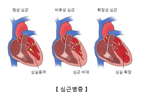 심장 전문의 만이 여기에서 도울 것입니다. 심실 빈맥 | 질환백과 | 의료정보 | 건강정보 | 서울아산병원