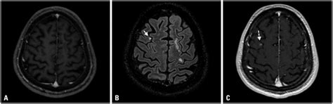 Cancers of the head and neck include cancers that start in several places in the head and throat, not including brain smoking is the most important risk factor for kidney and renal pelvis cancers. A 49-year-old male patient with renal cell cancer. (A) On ...
