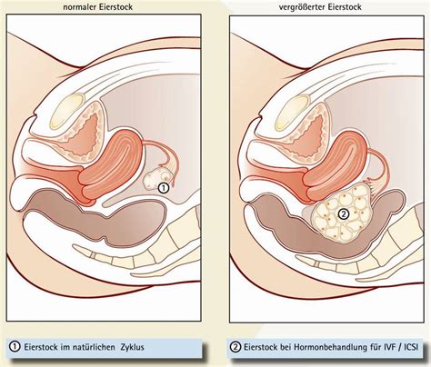 Die übertragung von zwei embryonen geht immer mit einem zwillingsrisiko einher. 43 Top Images Wann Einnistung Nach Transfer - Chancen und ...