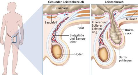 Eine schwellung in der leistengegend, die gut zu erkennen und zu ertasten ist. Ursachen von Leistenschmerzen: Leistenbruch, Schenkelbruch ...