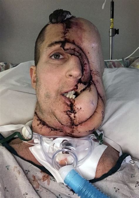 But in most dogs, bone cancer shows up slowly, often over a few months. Man who lost half his face to melon-size cancerous tumour ...