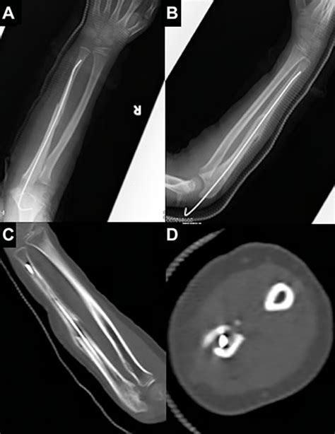 Full text Flexor Tendon Entrapment of the Index Finger ...