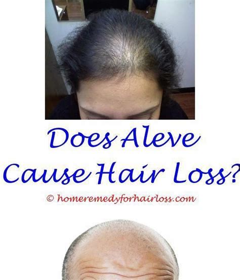 Alopecia, or hair loss, is listed as a rare side effect of adderall use by the u.s. Pin on Thinning Hair No More