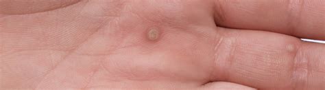 Warts are benign (noncancerous) fleshy growths on the skin caused by human papillomavirus (hpv). Warts and how to remove them