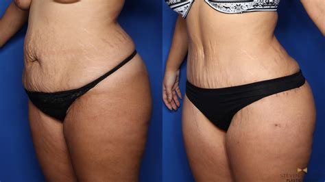 How much does it cost for a mommy makeover? Tummy Tuck Before & After Photos Patient 382 | Fort Worth ...