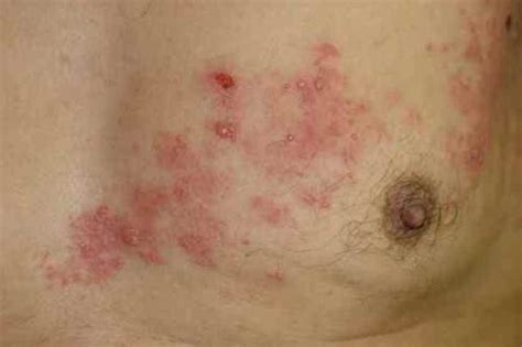 Dans le bas du dos, la douleur irradie dans la fesse, voire dans la jambe. ZONA INTERCOSTAL : le zona du ventre, du dos et des cotes ...