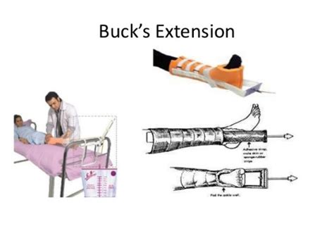 Chapter 8 from tom byrne, o.p.a.c., o.t.c., the common sense of traction. 견인장치(traction)종류 : 네이버 블로그