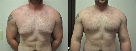 9what does male breast cancer feel like? Has anyone had success and feel satisfied after getting ...