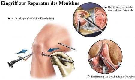 Da der innenmeniskus frei von nervenenden ist, schmerzt er selbst bei einer ruptur meist nicht. Meniskusriss im Knie, Schmerzen, Symptome, Operation, Anriss