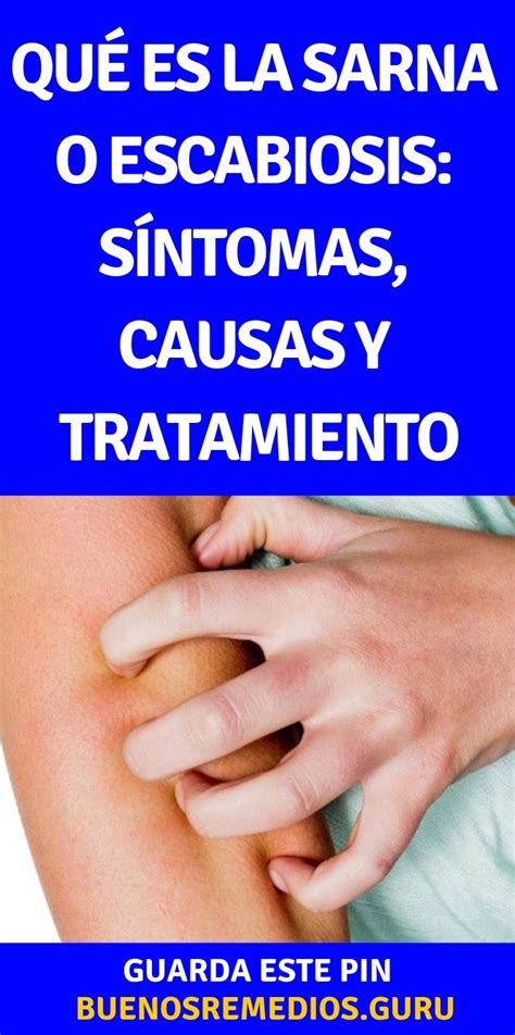 Quanto tempo dura o tratamento da sarna humana? Qué es la #sarna o #escabiosis: #síntomas, #causas y # ...