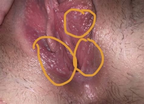 A lip sore with hard edges may be a form of skin cancer (see types of oral cancer; Is this genital herpes?? | Genital Herpes Simplex | Forums | Patient