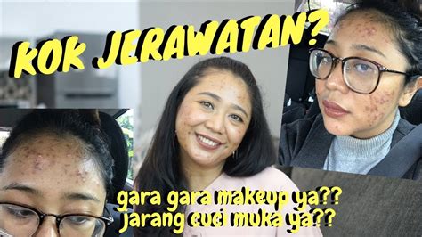 Ketika jerawat muncul di wajah, hal ini bisa menebak kesehatan kamu dan penyebab dari munculnya jerawat tersebut. KOK JERAWATAN ? MUKA NYA KENAPA?? PENYEBAB JERAWAT DI ...
