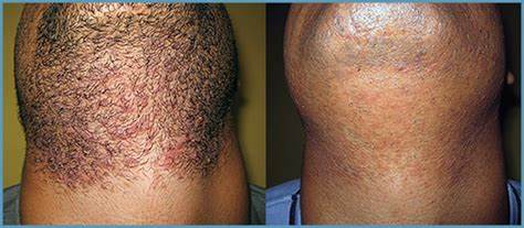 Results Of Laser Hair Removal You Should Know About