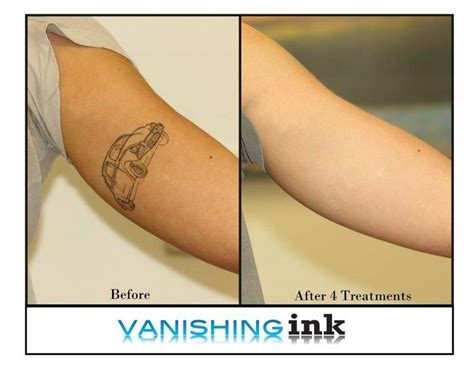 If you don't want to take your tattoos all the way off, you can simply lighten them enough to get some good cover. Vanishing Ink - Tattoo Removal Clinic - Tattoo Removal Services - BeautifulMe