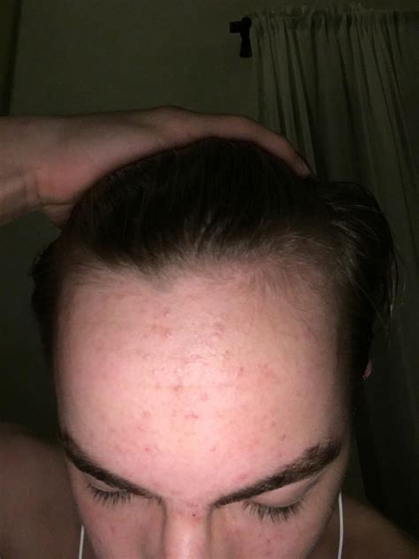 A receding hairline first starts at the temples (the area between the eye and the ear at the side of the head). Why do i have a receding hairline at 16 ...