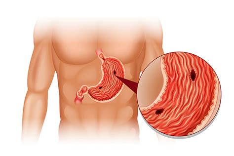 La dieta prevede tre pasti principali e due spuntini. Come riconoscere l'ulcera: sintomi e disturbi di questa ...