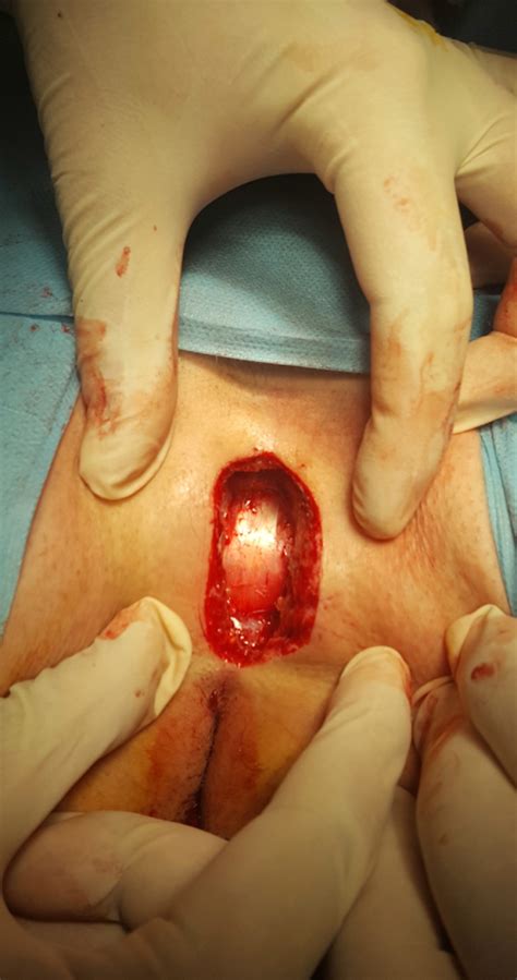 Friction and pressure — skin rubbing against skin, tight clothing,. Postsacral fascia after excision of the pilonidal cyst ...