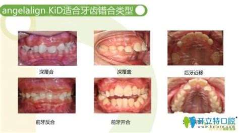 The site owner hides the web page description. 时代天使angelalign KiD儿童版:儿童隐形牙齿矫正的神器 - 前沿技术 - 开立特口腔