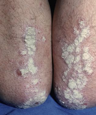 Clinical presentations vary from acute. Seborrheic Dermatitis, Psoriasis, Recalcitrant ...