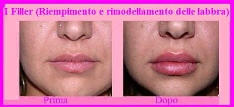 Con il tempo infatti anche la bocca, come il seno, il viso e. Fillers