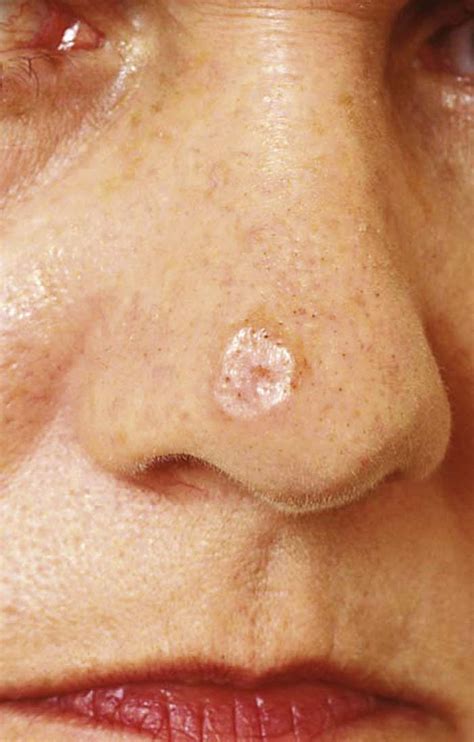 Amelanotic melanomas can resemble other skin cancers like basal cell or squamous cell carcinoma, or worse, may be mistaken for benign moles, scars or cysts. health inside fresh outside: Melanoma