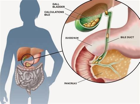 Diagram of liver gallbladder and pancreas. The Health Website : Gallstones