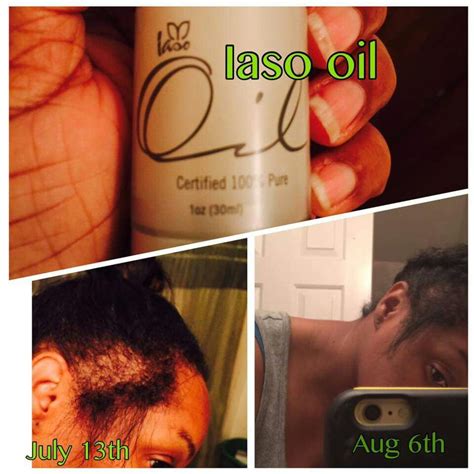 One of the leg ups emu oil has on other oils is that it has a small molecular size and similar compositions to our own natural skin oils. Results after 30 days. Laso Oil is pure emu oil | Pure emu ...