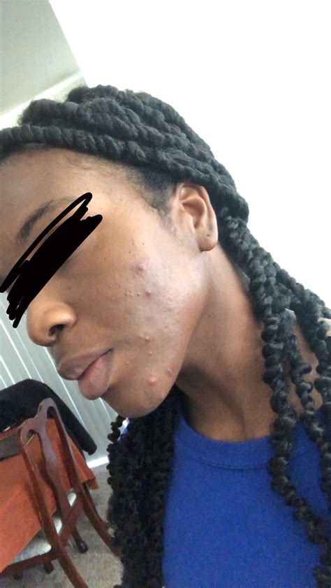 The retinoid is still active many months to even years after the expiration date. purge almost two weeks in! I'm anxious and hopeful it will ...