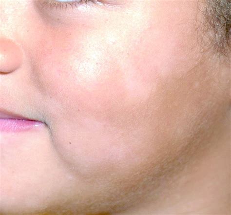 White patches on the face might be the effect of vitamin deficiency in the body. Little white spots: an approach to hypopigmented macules ...