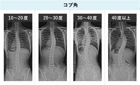 側弯症 | 院長日記 | 百合ヶ丘の整骨院なら1回で効果の実感 ...