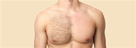 To get impressive results and avoid serious side effects, it's important to know these basic facts before you have laser treatment for a scar. The Top Risks and Side Effects of Laser Hair Removal You ...