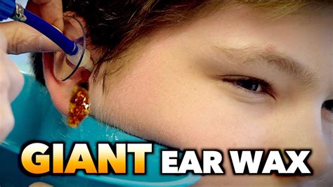 Basically, something like a small vacuum cleaner tube is inserted in your ear to remove gunk and old wax. GIANT EAR WAX REMOVAL! | Dr. Paul - YouTube