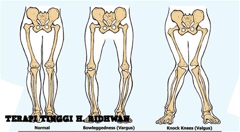 Kelainan tulang yang disebabkan kecelakaan dapat berupa memar dan fraktura. Terapi Pengobatan Untuk Kelainan Kaki X dan Kaki O