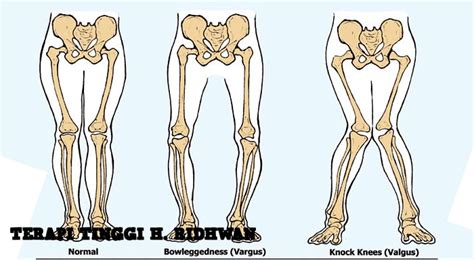 Maybe you would like to learn more about one of these? Terapi Pengobatan Untuk Kelainan Kaki X dan Kaki O