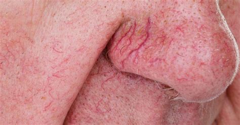 Broken blood vessels on face: Causes, treatment, and home remedies