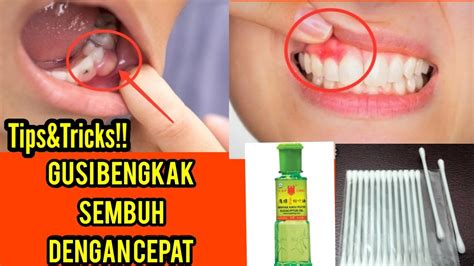 Lakukan cara ini selama beberapa kali hingga bisul bisa mengeluarkan nanah dan bengkak hilang. DIJAMIN AMPUHH..!! Cara Mengatasi Gusi Bengkak dan ...