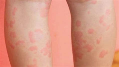 Jika mengalaminya, mama bisa mengganti sabun dengan produk pembersih kulit lainnya yang lebih lembut dan tidak mengandung alkohol. Obat Biduran Alami yang Bisa Dicoba di Rumah, Bisa Redakan ...