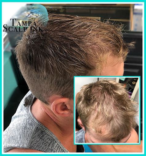 Why do you feel pain on top of the head scalp? Scalp micropigmentation to cover hair thinning with a soft ...