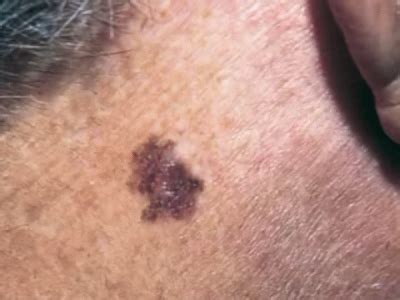 When you notice a new spot, does it appear different? What is skin cancer?: Malignant Melanoma pictures