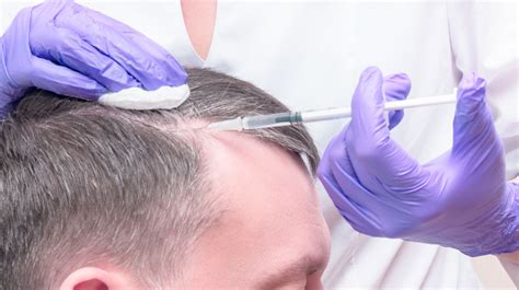 I began each session with a scalp detox with the herbs & clay peeling cleanser. PRP for Hair Loss - Bradford Skin Clinic and Medical Spa