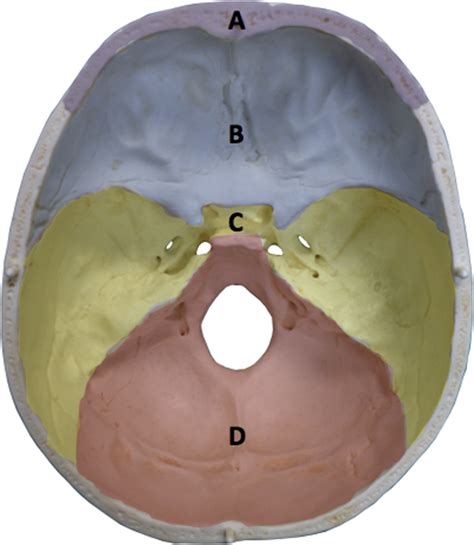 A novel classification of frontal bone fractures: The prognostic ...