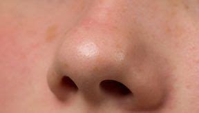 La mucormicosis es una infección por hongos saprofitos de la cavidad nasal y senos paranasales de los géneros mucor, absidia y rhizopus. Mucormicosis: Todo lo que debes saber de esta enfermedad