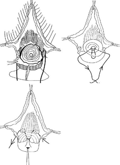 What does sturmdorf suture mean? Management of Prolapse - Urogynecology: Evidence-Based ...