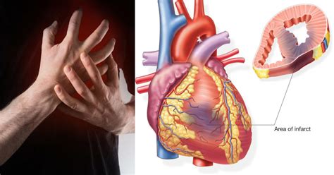 A report of the american college of cardiology. Myocardial Infarction (Heart Attack) | Top Neuro Docs