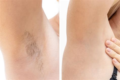 The new technology has really changed the game. when laser hair removal was first introduced, it worked best on light skin. How Long Does Laser Hair Removal Last? - Laser Hair ...