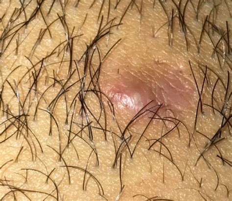 Ingrown hair cyst develops after wrong hair removal habits and result in many complications. Infected Ingrown Hair Cysts Symptoms, Pictures, Causes on ...