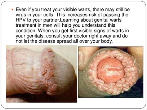 The best and easiest way to remove warts depends on the location of the wart. Energy healers ny, treatment for hpv in males