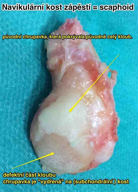 O neexistenci příznaků virového infekčního onemocnění covid 19. Poranění zápěstí - Chirurgie ruky | IC Klinika Brno