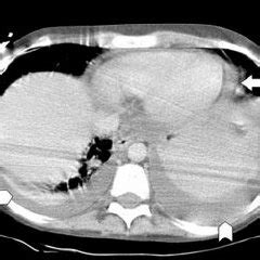 Patients with pneumonia have a poorer ct can aid with the identification and quantification of effusions. Chest CT scan of a patient in our series with bilateral ...