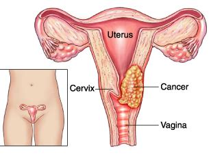 Hpv 16 dan hpv 18 merupakan jenis yang menyebabkan kanker serviks. Jenis Penyakit Yang Dapat Menyerang Wanita ~ Solusi Alami ...